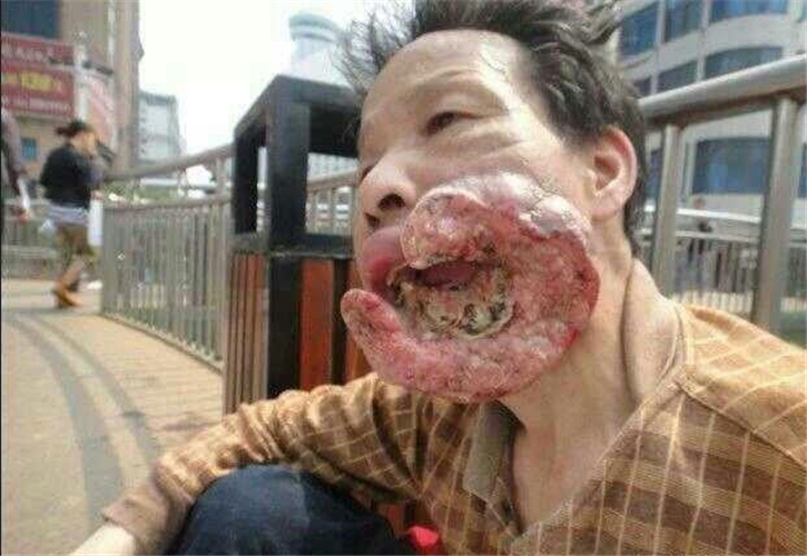 男性頰癌什麼樣