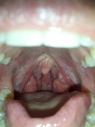 食道炎的症狀圖 (52) 