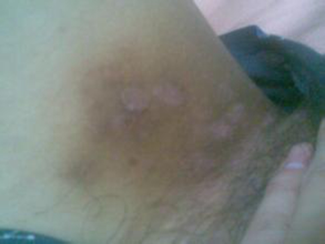 孕婦外陰瘙癢的症狀