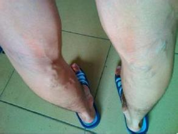 男士小腿靜脈曲張 