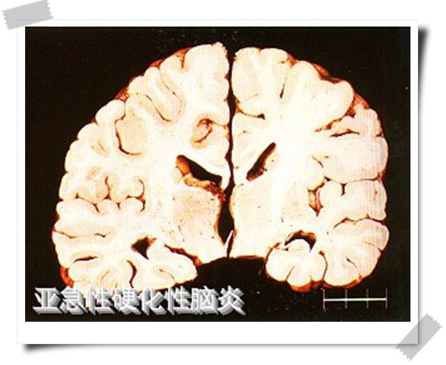 亞急性硬化性腦炎