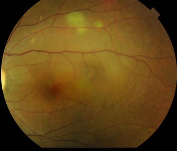 中心漿液性視網膜脫落