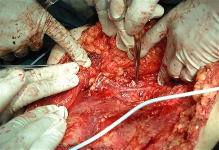 摘除乳腺纖維瘤手術