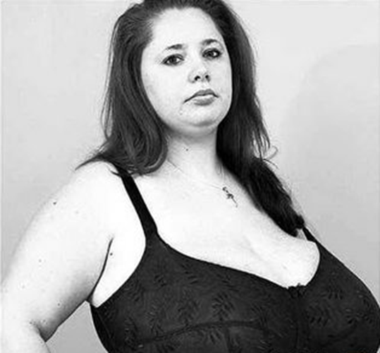 巨乳症怎樣處理