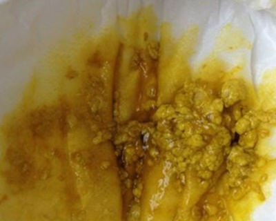 新生兒消化不良大便圖 (63) 