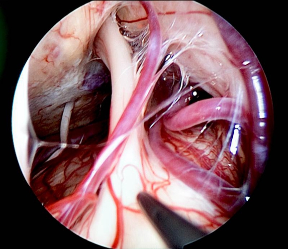 血管減壓治療三叉神經痛