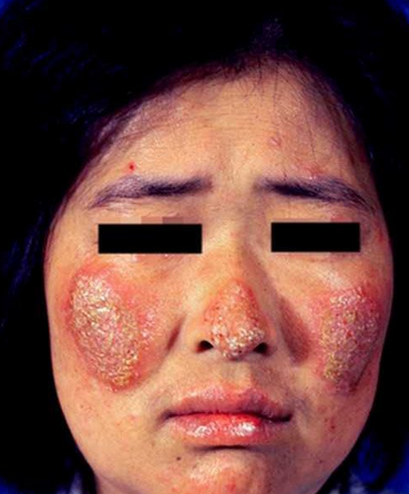 系統性紅斑狼瘡診斷標準 (51) 