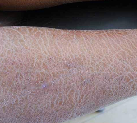 小腿皮膚像魚鱗 (53) 