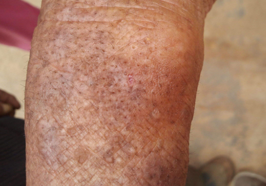 皮膚澱粉樣變 (60) 