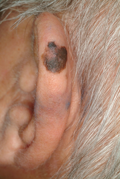 黑痣癌變的徵兆