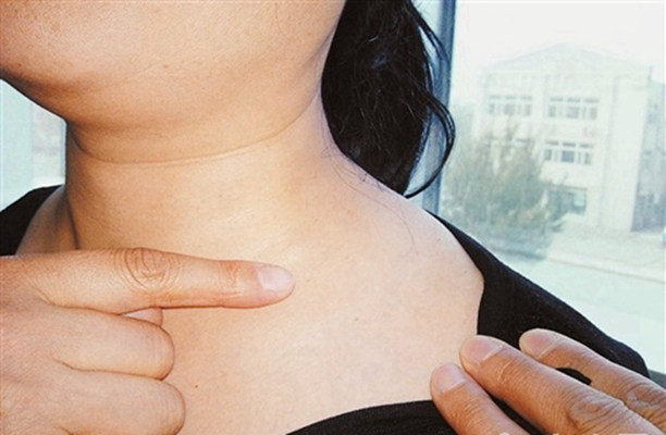 頜下淋巴結腫大