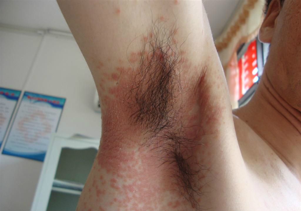 腋下皮膚念珠菌病