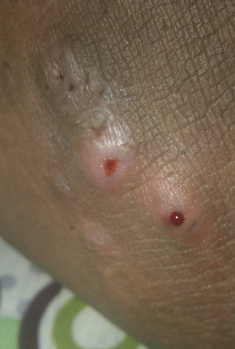 腋下皮囊炎用什麼藥啊 