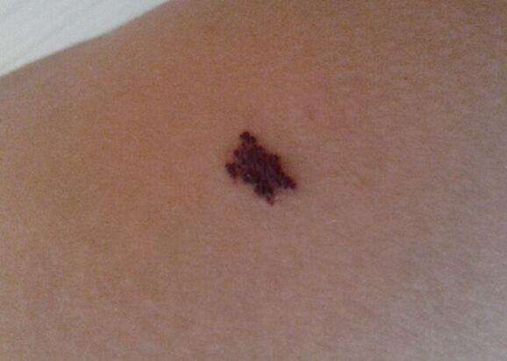 黑痣癌變