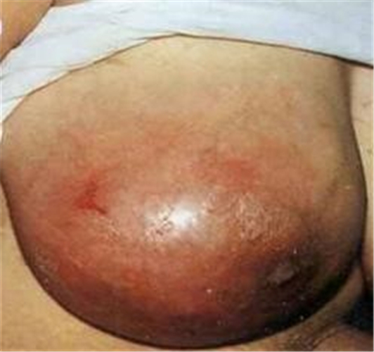 什麼樣是乳腺炎