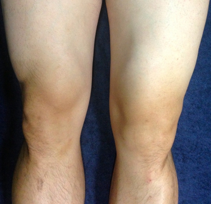 膝蓋骨質增生 (48) 