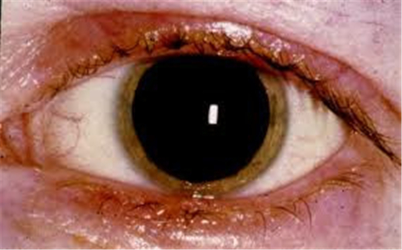 腦疝瞳孔什麼樣