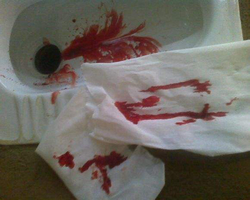 結腸癌症狀 (48) 