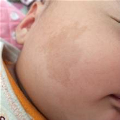 牛奶咖啡斑 (43) 