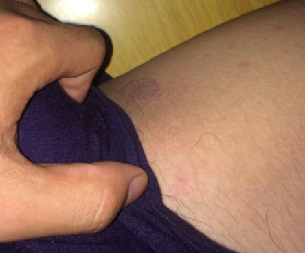 體股癬初期現象