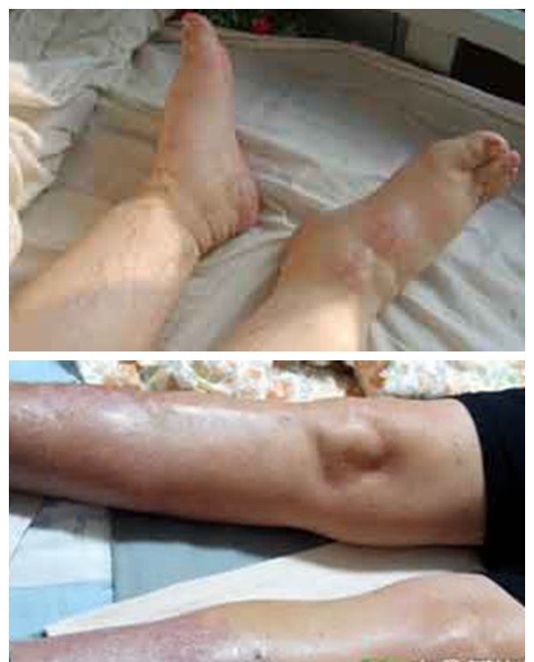 糖尿病腎病腫起程度變化