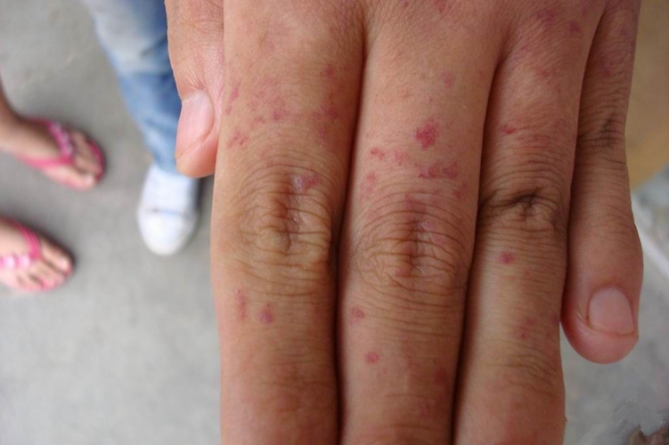 肢端血管角皮瘤皮膚腫瘤