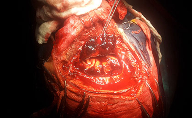 硬膜下血腫 (43) 