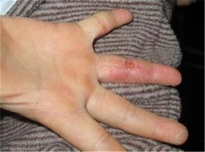 手指良性骨腫瘤