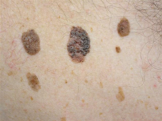 黑痣癌變的徵兆