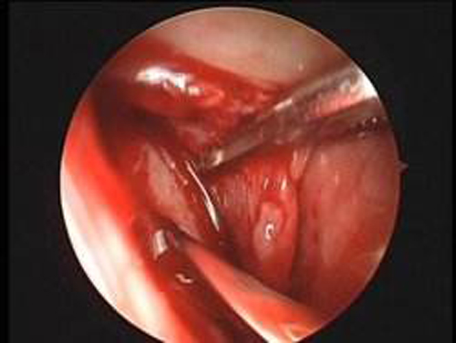 正在進行檢查的慢性鼻炎