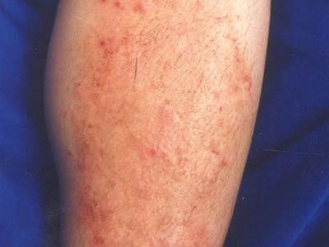 腿部的放射性皮炎的