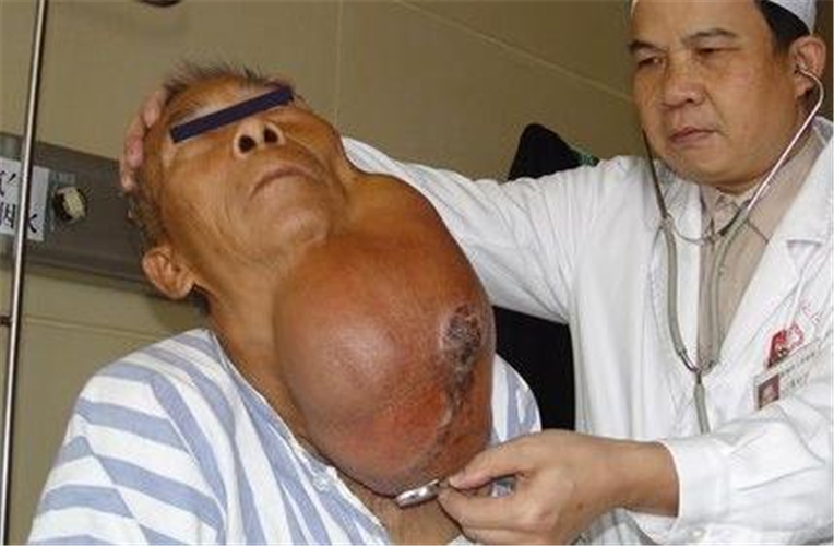 嚴重的甲狀腺結節