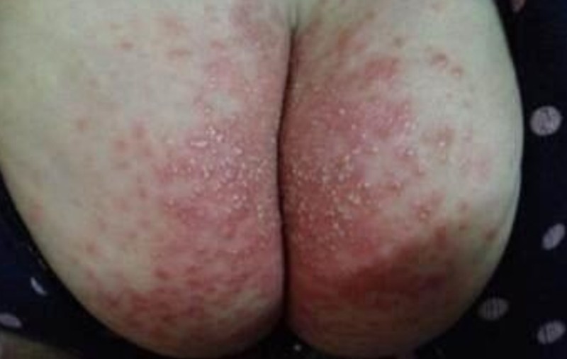 肛周溼疹男性治療的方法