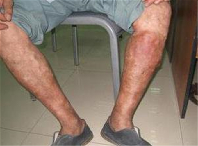 血栓性靜脈炎症狀