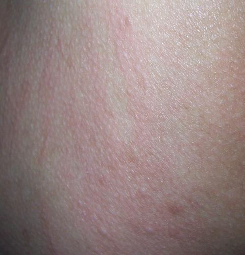 藥物性皮炎藥物疹症狀