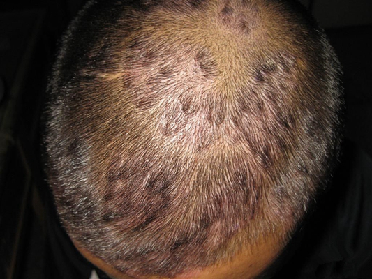 頭皮脂溢性皮炎 (44) 