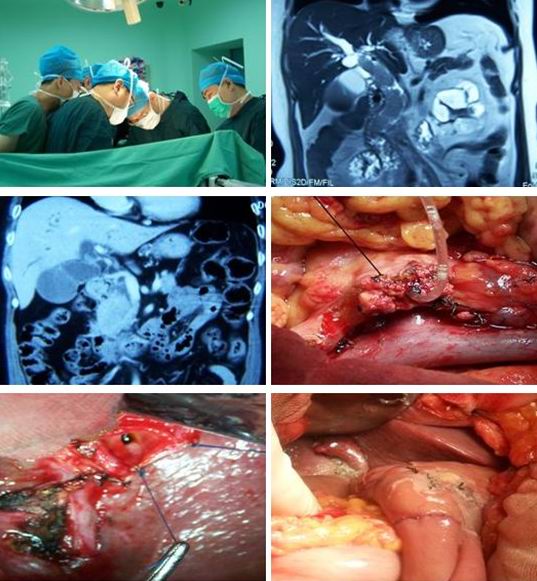 肝門膽管癌晚期