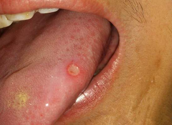 舌癌的初早期症狀