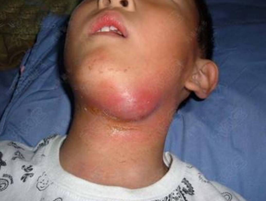 非霍奇金淋巴瘤症狀