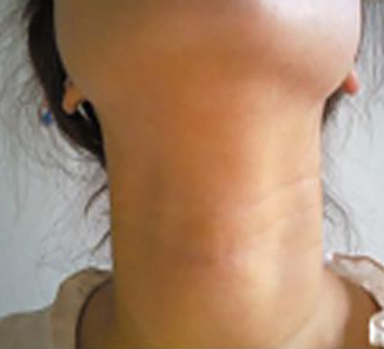 亞甲狀腺炎的早期症狀