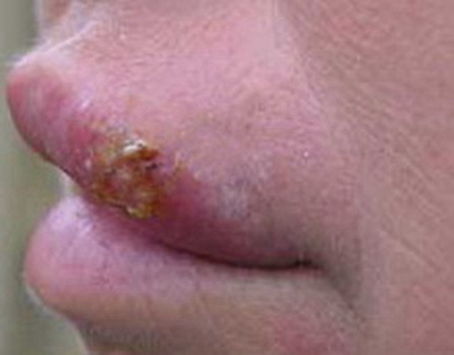 口唇皰疹痂掉了