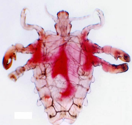 陰蝨治療費用的