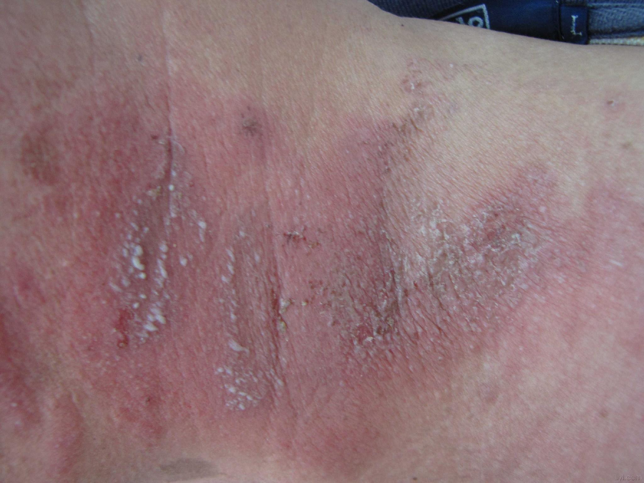 隱翅蟲皮炎頸部