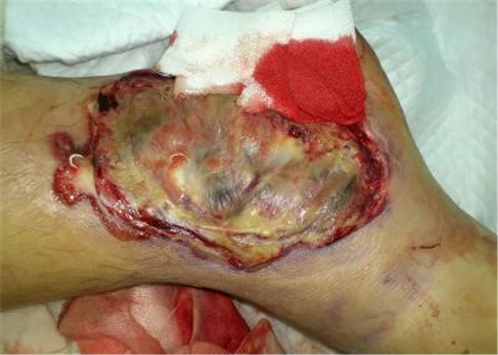 需要清創的糖尿病足