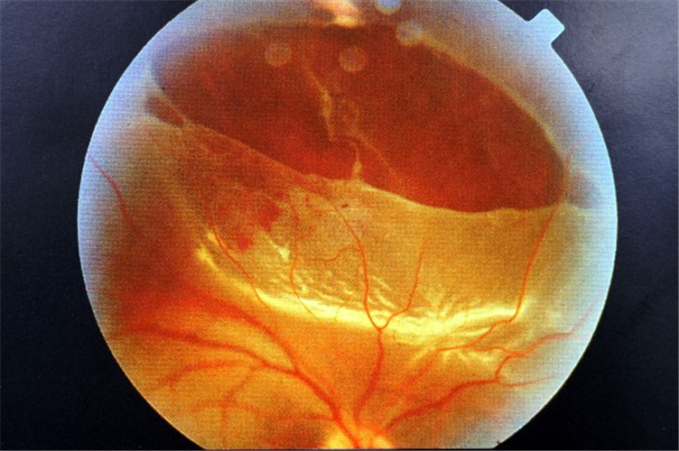 嚴重視網膜脫落