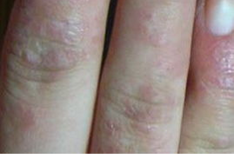 手指夏季皮炎症狀