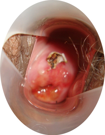 宮頸癌的早期症狀