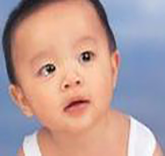 嬰兒甲狀腺腫大