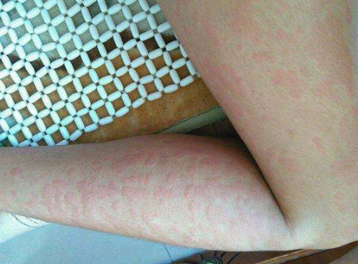 身體蟎蟲過敏症狀