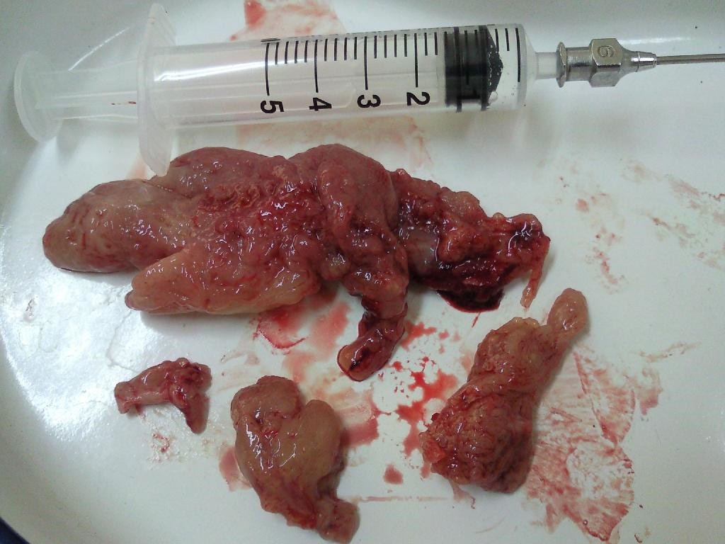 手術割下來的喉腫瘤